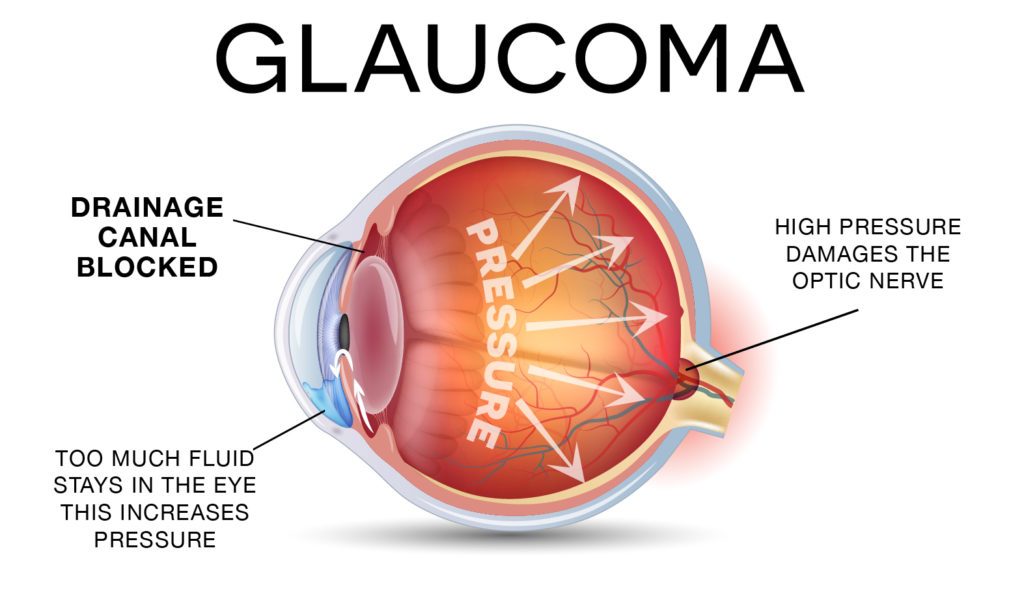 Understanding Eye Pressure