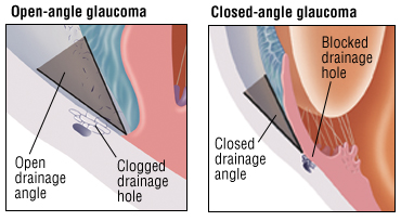 Open-angle glaucoma